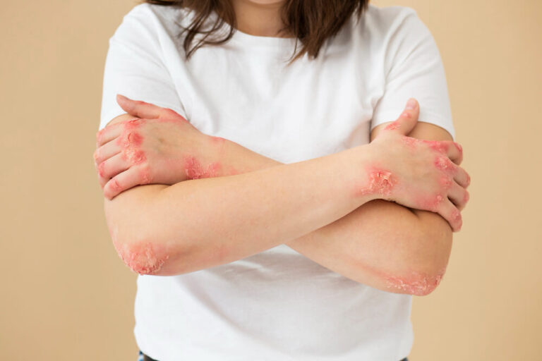 itchy dry skin or an itchy rash. aaa - Allergy Asthma & Dermatitis Center
